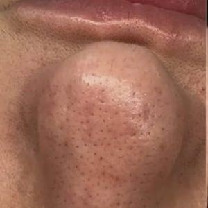 قبل از پاکسازی منافذ باز پوست با فیشال کلاسیک در کلینیک پری بهلول اسلامشهر